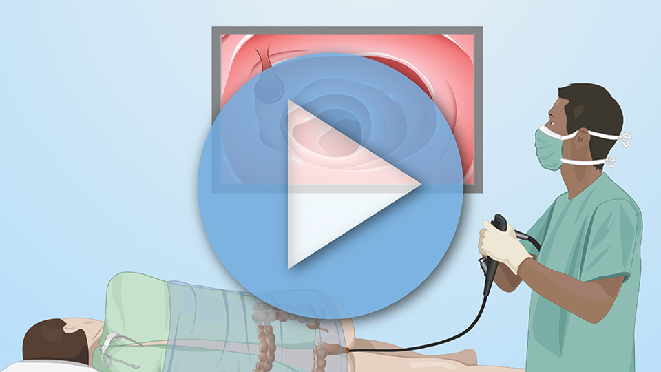 Animation - What is Colon Cancer?
