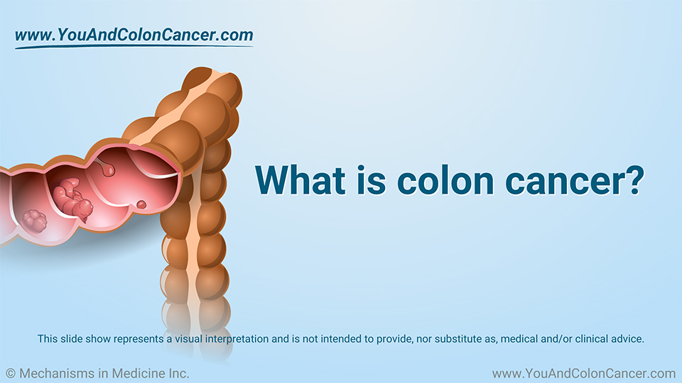 Slide Show - What is Colon Cancer?