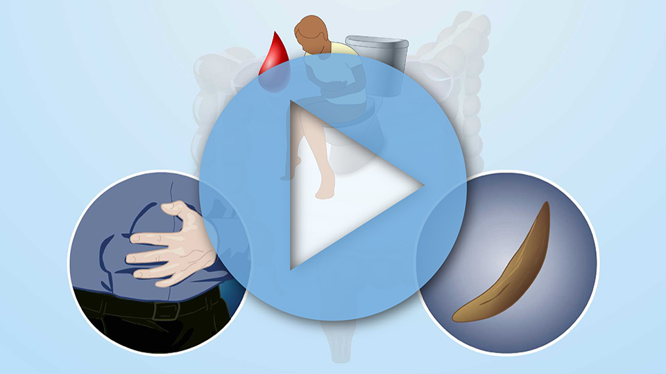 Animation - What are the Symptoms of Colon Cancer?