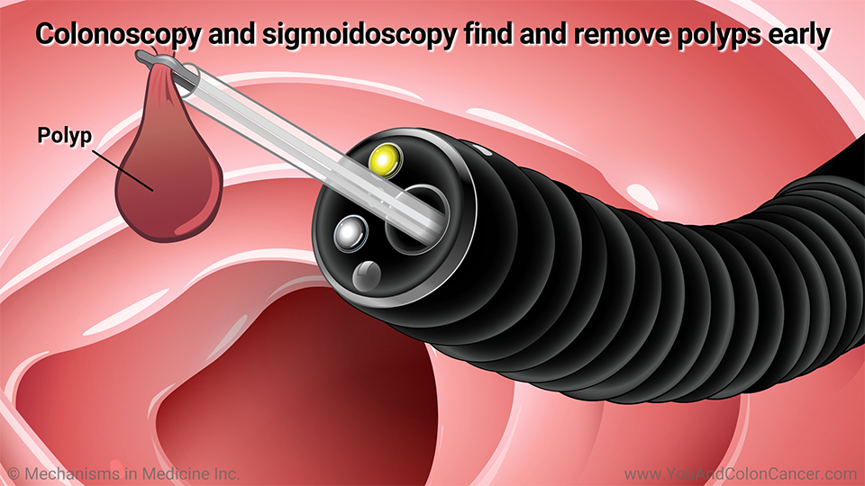 Colonoscopy and sigmoidoscopy find and remove polyps early