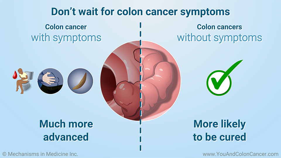 Don’t wait for colon cancer symptoms