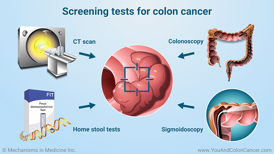 Screening tests for colon cancer
