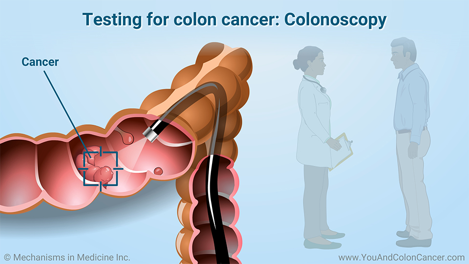 Testing for colon cancer: Colonoscopy