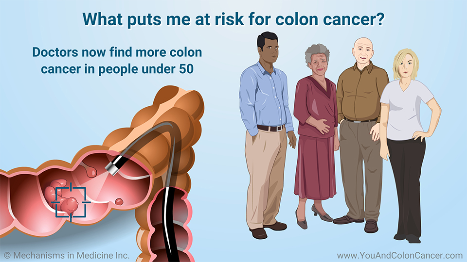 What puts me at risk for colon cancer?