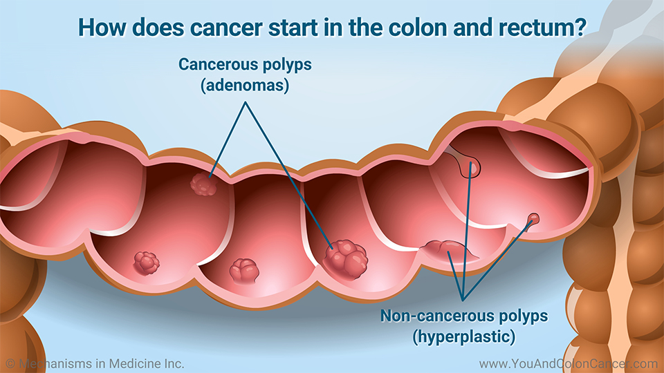 How does cancer start in the colon and rectum?