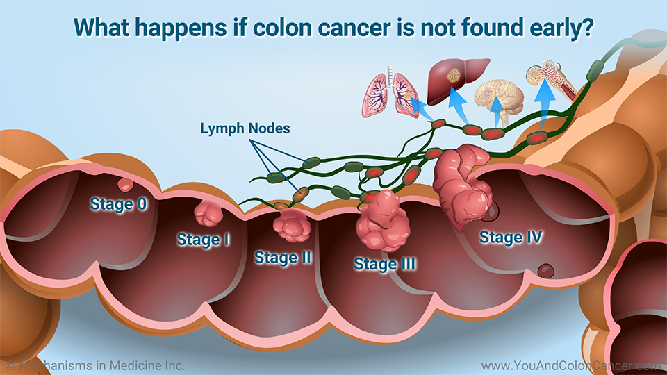 What happens if colon cancer is not found early?