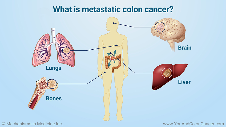 What is metastatic colon cancer?