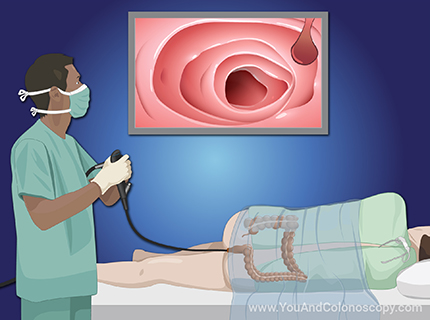 
          Colonoscopy is a screening process for cancer detection.
          Find out what happens and how to prepare.
        