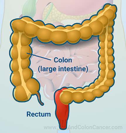 New to this resource? Follow our visual guide on colon cancer